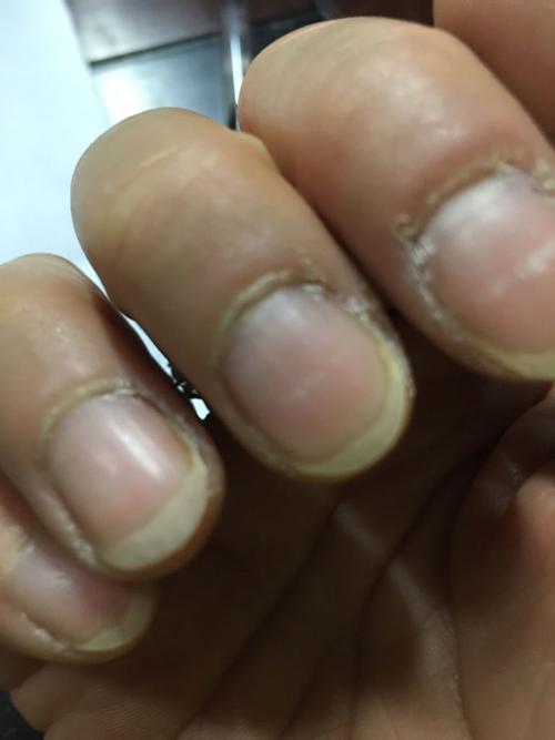 手指甲旁边的皮肤开裂还很硬怎么回事?