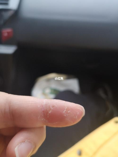 手指头烂成这样,我也是厉害的_美妆_美甲