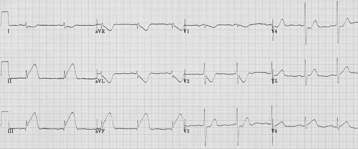 典型下壁心肌梗死心电图