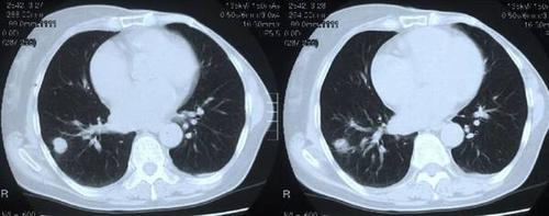 egfr-tki临床治愈晚期肺癌