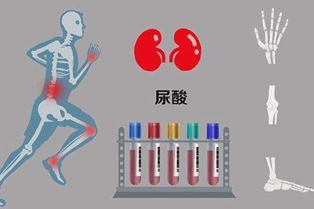 细数高尿酸血症"不可饶恕"的"五宗罪"
