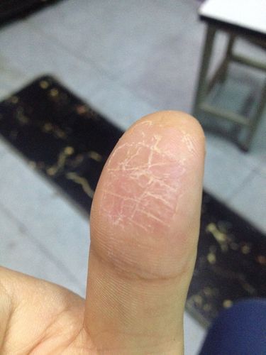 手指干燥,开裂,再过几天估计又要开口了,会很痛的,已经是第二次了,第