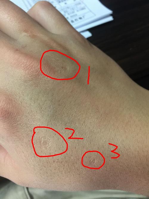 鱼鳞痣怎么去除