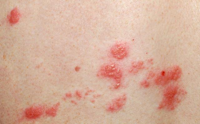 玫瑰糠疹到底是什么病这4类人要警惕别等中招才预防