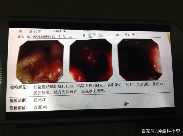 肛门癌不是悄悄到来,出现5个症状,要留个心眼,不能忽视