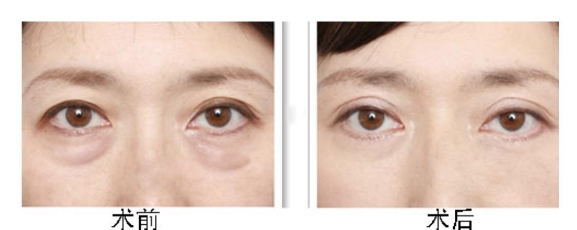 外切去眼袋手术对比照片