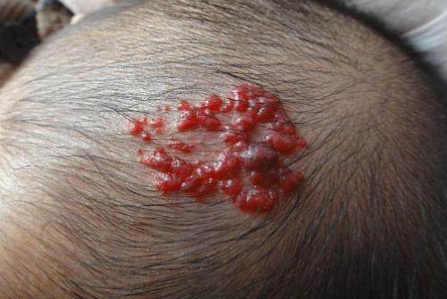 你家宝宝的血管瘤还在继续生长吗?家长们要注意了!