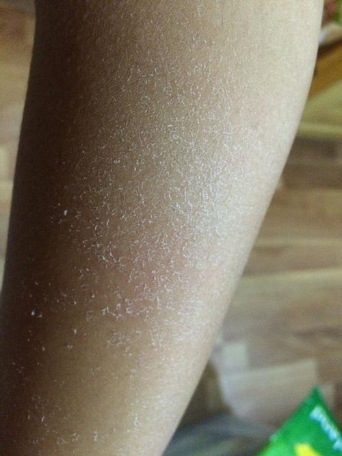 手臂掉皮 怎么回事?