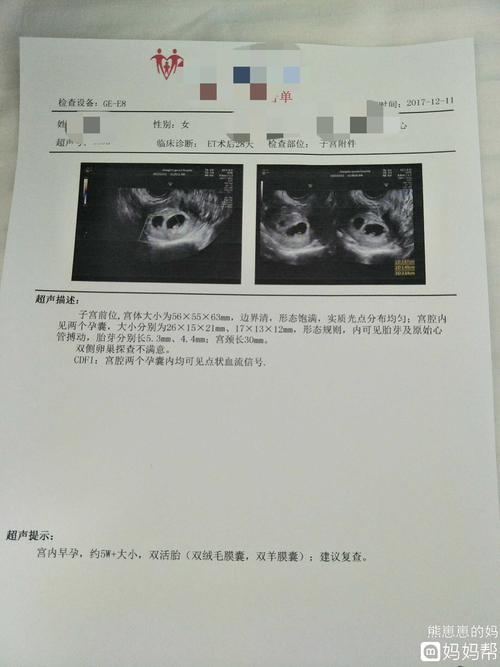 双胎看看孕囊吧