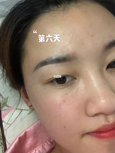 我是洗完以后结痂掉完痂以后接着洗的,没经历恢复期,就是有点感觉眉毛