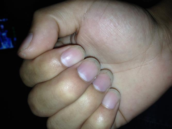 应该有一段时间了这指甲颜色感觉偏紫色害怕身体哪出现问题