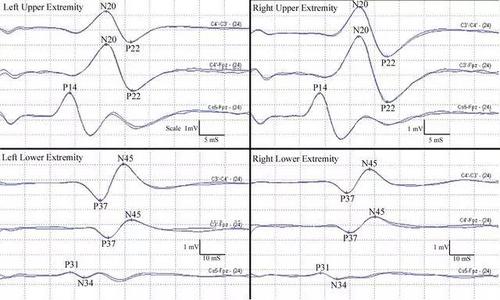 体感诱发电位(se