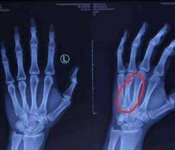 掌骨骨折:直接暴力伤易横行骨折,间接外力或扭转时易斜形或螺旋形骨折