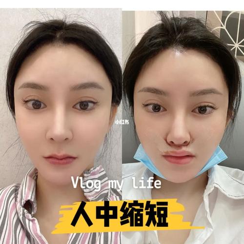 人中缩短(全切内缝合)第16615天_全切双眼皮_双眼皮手术_疤痕