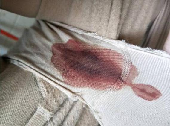 女性感染了hpv病毒以后,也会出现白带发黄的情况,因为宫颈粘液是白带