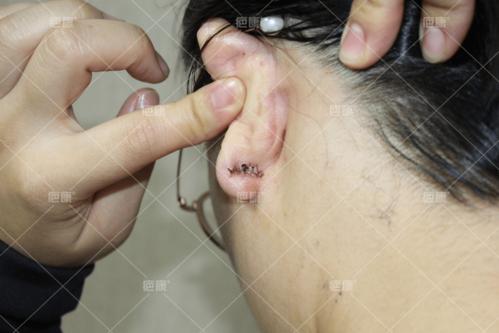 w女士两年前因打耳洞导致疤痕疙瘩,刚开始没在意,慢慢发现疙瘩越来越