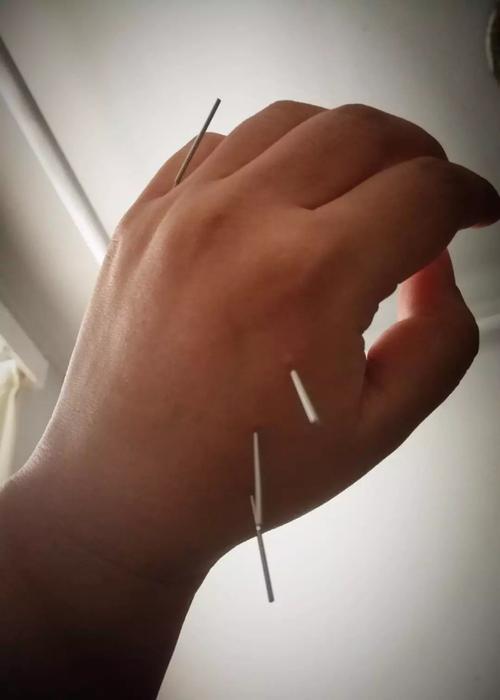 手把手教会你针灸治疗感冒发烧头痛咳嗽为家人收藏