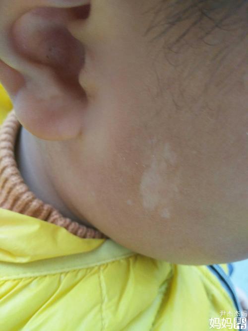 (第2页) - 宝宝疾病 - 妈妈帮