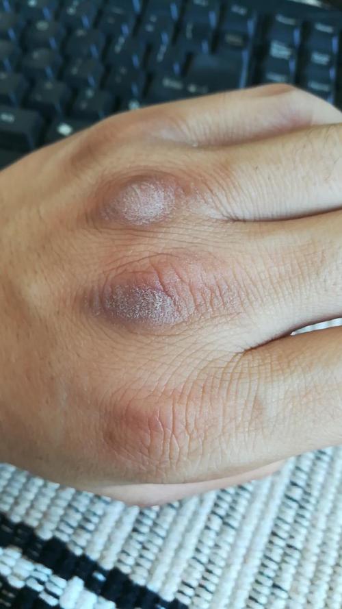 手指关节处皮肤变粗糙,变黑(有照片)