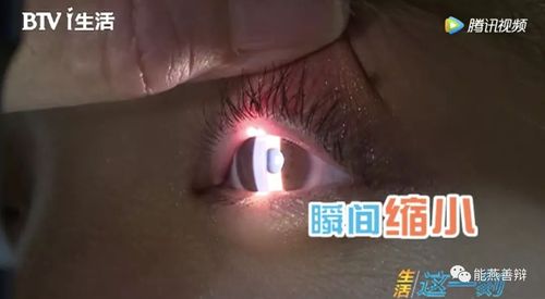 但在光源的直射情况下瞳孔从放大瞬间缩小,而且随着光度的不断增强