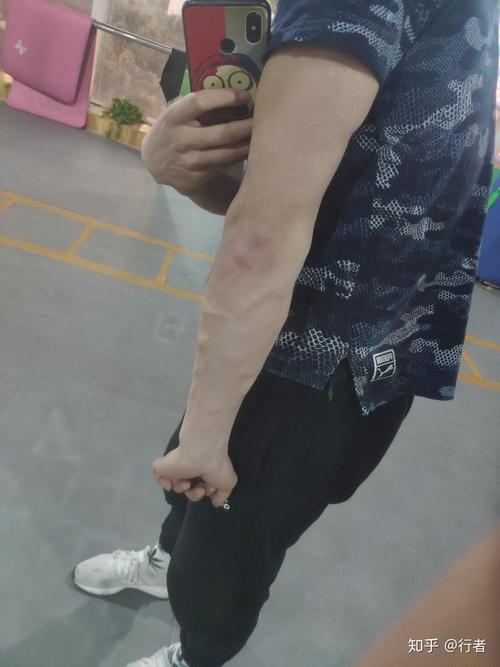 全身多发性脂肪瘤图片 (第1页)