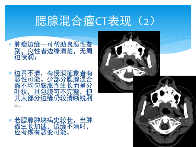 腮腺混合瘤影像诊断2015.12.28
