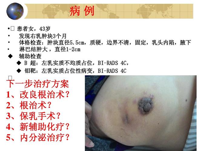 乳腺癌外科治疗进展ppt