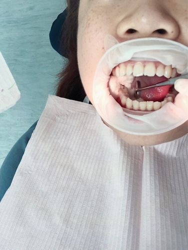 我的拔牙和补牙都报销了,坐等下周带牙套了.
