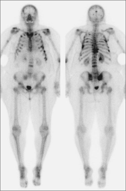 图2.  全身骨扫描