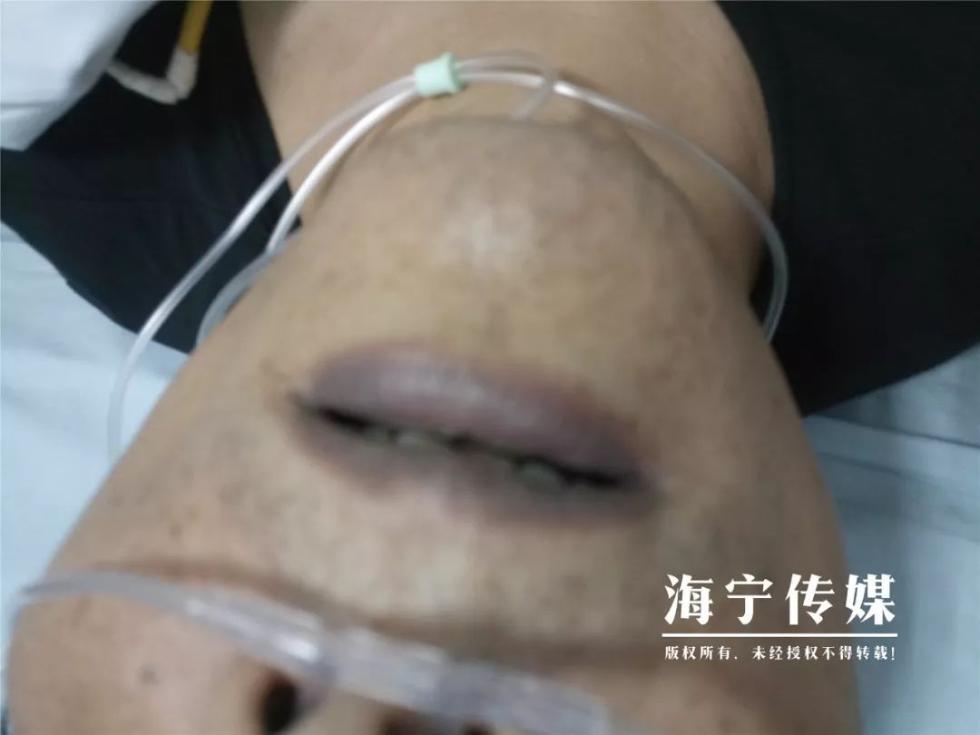 中毒严重的人嘴唇会发紫