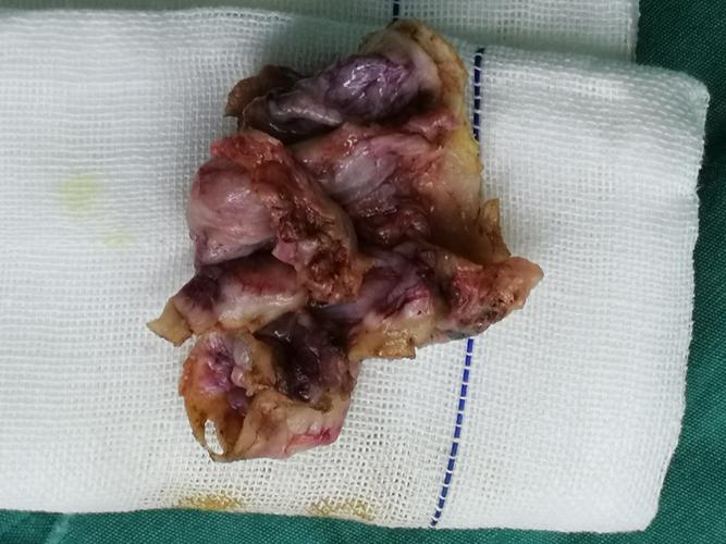 妇产科完成一例腹腔镜下巨大卵巢囊肿切除术.