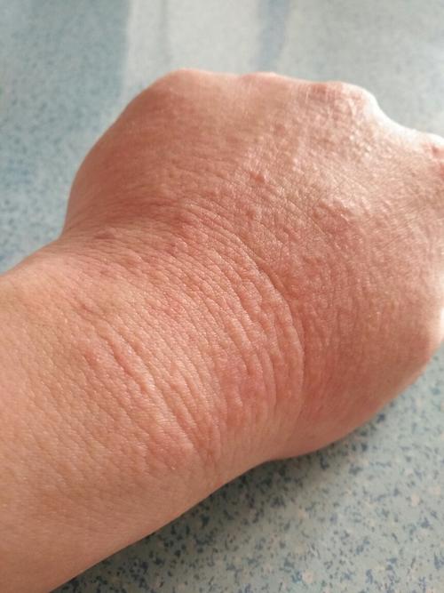 手上起的这是什么皮肤病,很痒,快十年了,反反复复,怎么治疗,谢谢了