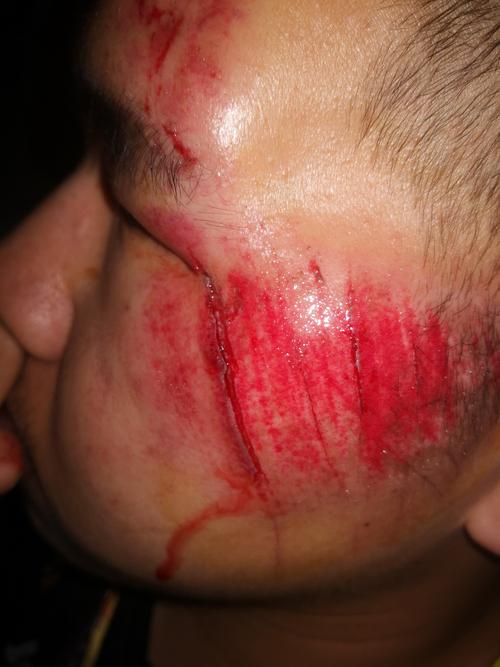 骑车摔倒了,脸上会留疤吗?