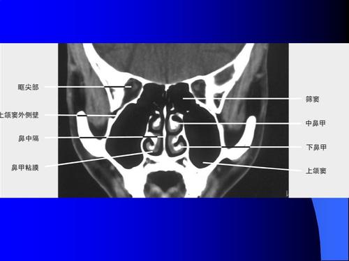 鼻和鼻窦ct解剖ppt