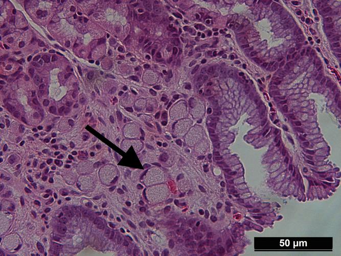 胃癌的印戒细胞癌,h&e染色,400x