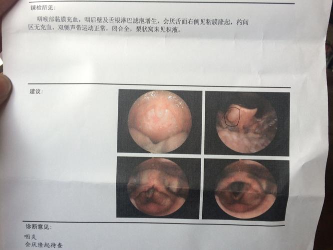 咽炎,会厌隆起,医生说要手术去掉,求助.