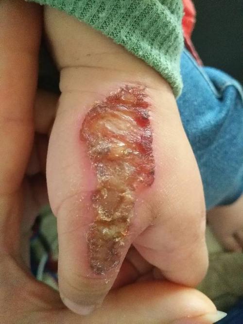 宝宝蹭伤结痂中间黄黄的是怎么回事