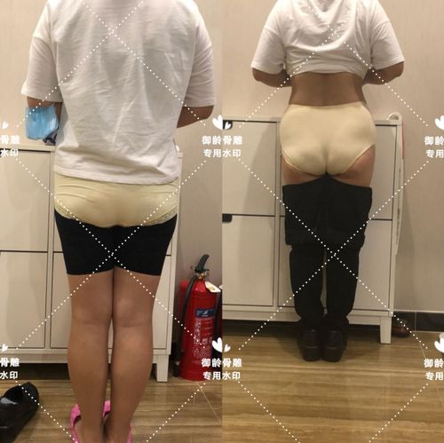 骨盆修复后体型的变化