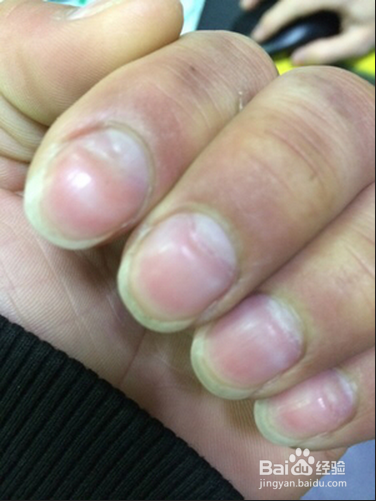 指甲上有横纹是怎么回事