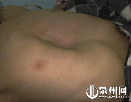 水升凹陷的胸部可以放下一个拳头