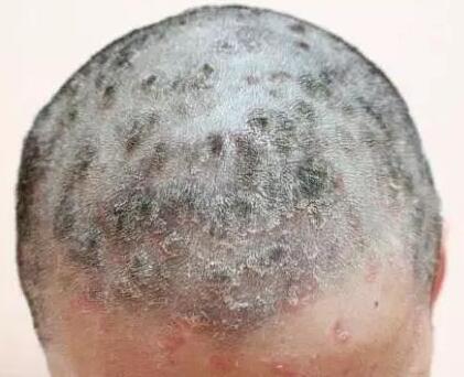 脂溢性皮炎的预防