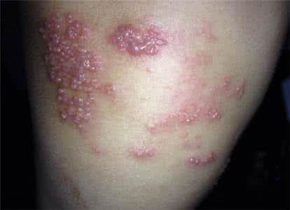 蛇胆疮怎么引起的 蛇胆疮怎样治疗