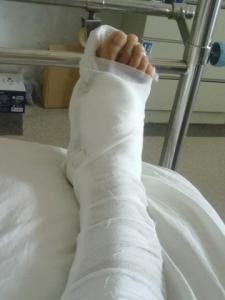 女子骨折手术去世 司法鉴定:医院对患者术后治疗存明显不足