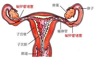 女性输卵管堵塞的症状表现有什么?