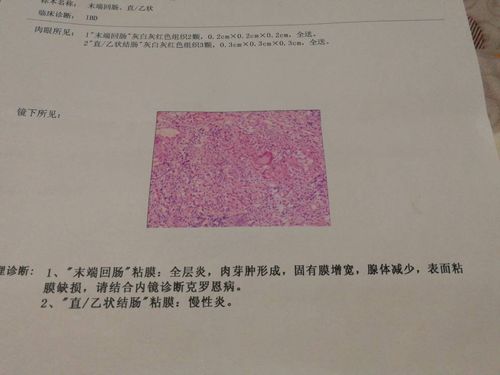 最后半年我少吃肉多吃蔬菜大便基本上成型,但是检查出来还是克罗恩病