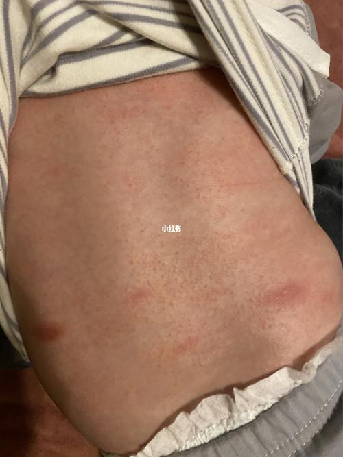 后背突然长的这个 是湿疹还是干疹还是过敏_过敏_湿疹