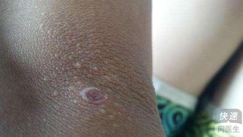 肛周炎有哪些特点 如何进行防御