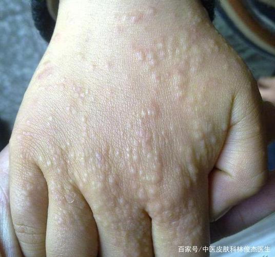 当小孩手上出现密集小丘疹,可能和这些玩具有关.