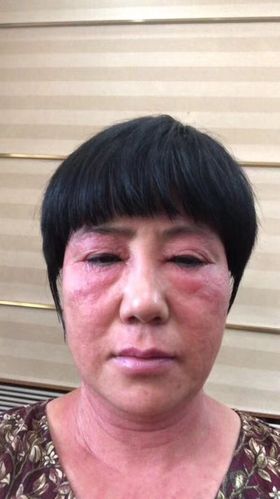 如不添加激素,重金属,遇到激素依赖性皮炎皮肤立即引发皮肤激素反跳