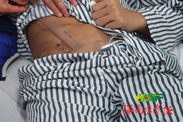 海医二附院成功完成海南首例abo血型不相容肾移植手术